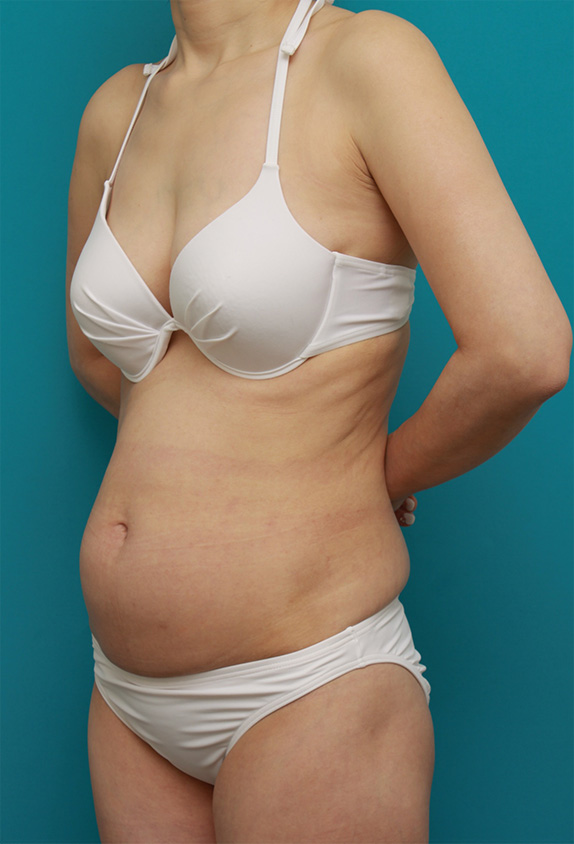 症例写真,お腹回り、ウエスト、腰の皮下脂肪をイタリアン・メソシェイプ（イタリアンメソセラピー）・脂肪溶解注射で除去した症例写真,Before,ba_meso59_b.jpg