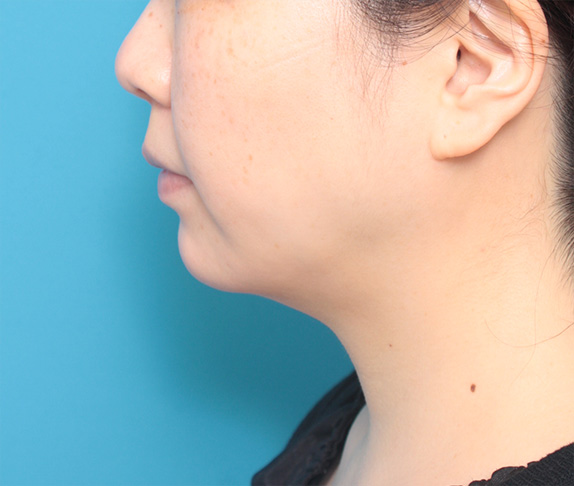 イタリアン・メソシェイプ（イタリアンメソセラピー）・脂肪溶解注射の症例　頬、あご,After,ba_meso69_a01.jpg