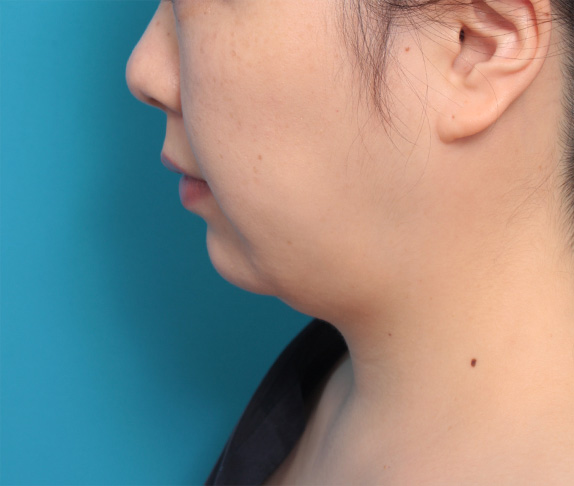 イタリアン・メソシェイプ（イタリアンメソセラピー）・脂肪溶解注射の症例　頬、あご,Before,ba_meso69_b.jpg