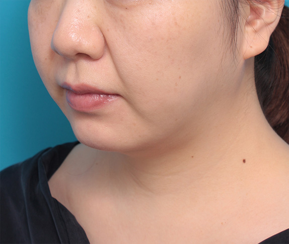 症例写真,イタリアン・メソシェイプ（イタリアンメソセラピー）・脂肪溶解注射の症例　頬、あご,Before,ba_meso70_b.jpg