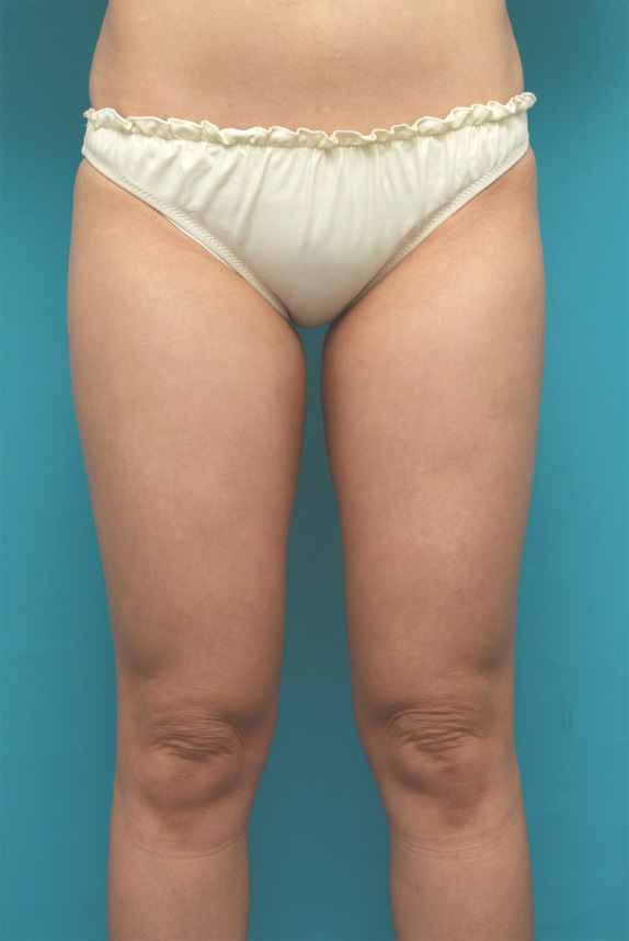 イタリアン・メソシェイプ（イタリアンメソセラピー）・脂肪溶解注射で太ももが一周り細くなった症例写真,After（6回目注射後2ヶ月）,ba_meso71_a01.jpg