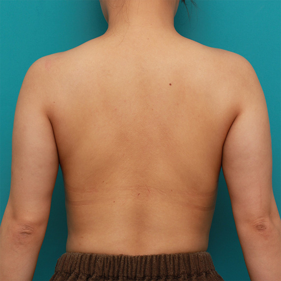 イタリアン・メソシェイプ（イタリアンメソセラピー）・脂肪溶解注射,二の腕から背中、肩にかけての皮下脂肪をイタリアン・メソシェイプ（イタリアンメソセラピー）・脂肪溶解注射で細くした症例写真,After（6回目注射終了後）,ba_meso81_b.jpg
