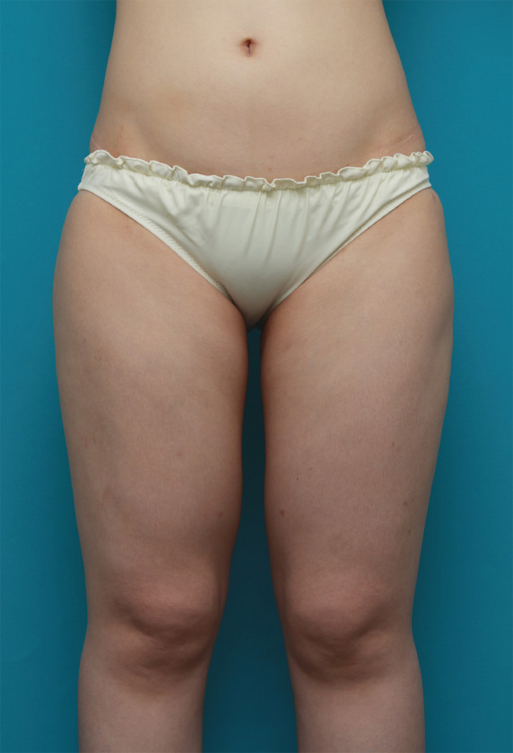 お尻から太もも全体にかけてイタリアン・メソシェイプ（イタリアンメソセラピー）・脂肪溶解注射を行い、一回り細くした症例写真,Before,ba_meso82_b.jpg