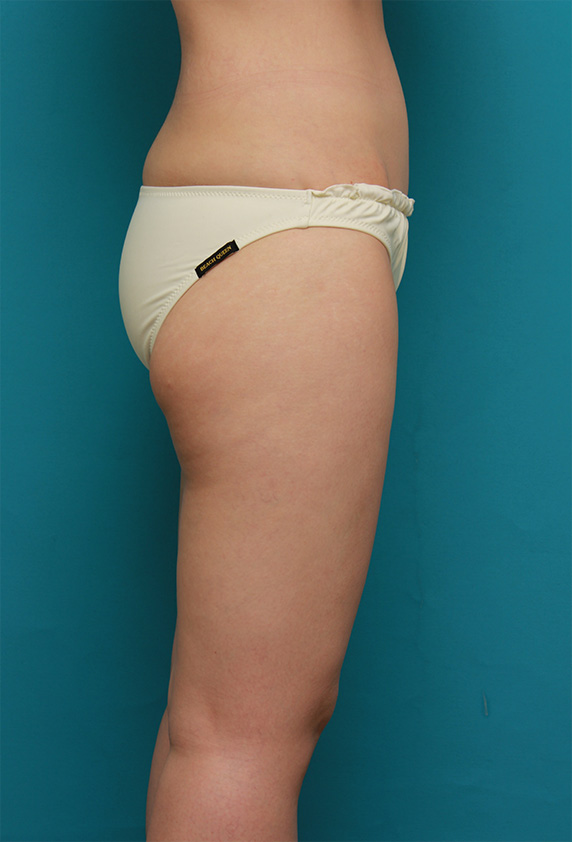 症例写真,お尻から太もも全体にかけてイタリアン・メソシェイプ（イタリアンメソセラピー）・脂肪溶解注射を行い、一回り細くした症例写真,After（6回目注射後）,ba_meso84_b.jpg