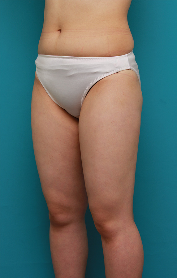 症例写真,太もも全体~お尻を細くしたイタリアン・メソシェイプ（イタリアンメソセラピー）・脂肪溶解注射の症例写真,After,ba_meso89_b.jpg