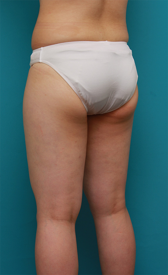 症例写真,太もも全体~お尻を細くしたイタリアン・メソシェイプ（イタリアンメソセラピー）・脂肪溶解注射の症例写真,After,ba_meso91_b.jpg