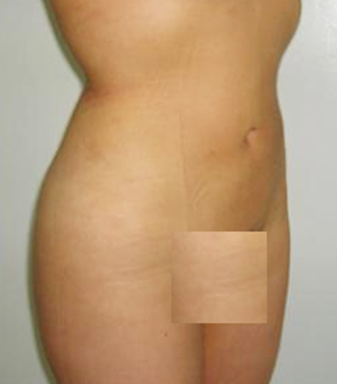 ミケランジェロ（TM）,ミケランジェロ(TM) 腹部全体の脂肪を減らした患者様の症例,After,ba_michelangelo01_b.jpg