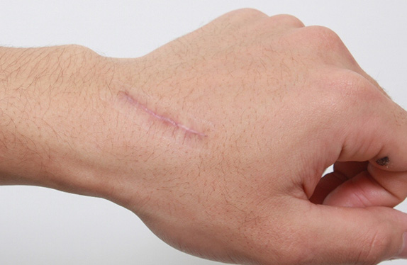 傷跡,根性焼き痕の切除縫縮手術の症例写真,After(1ヶ月後),ba_keisei17_b.jpg