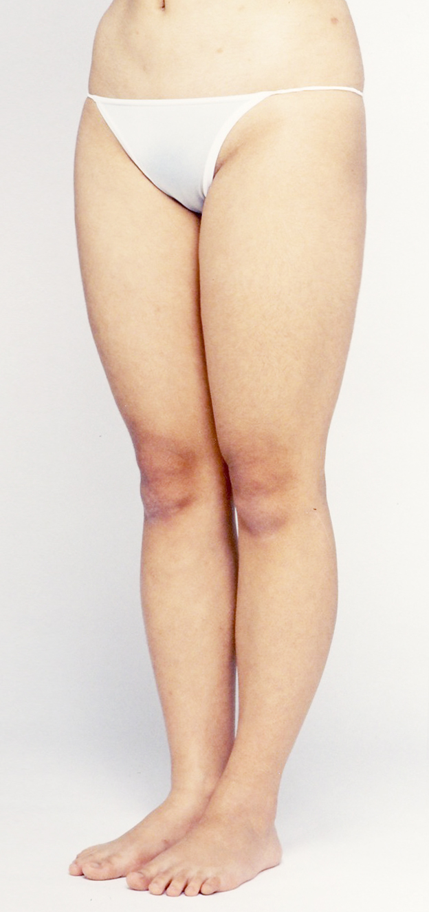 脂肪吸引,太もも全体（前面、後面、内側、外側、膝上）とふくらはぎの脂肪吸引をした30代女性の症例写真,Before,ba_shibokyuin35_b.jpg