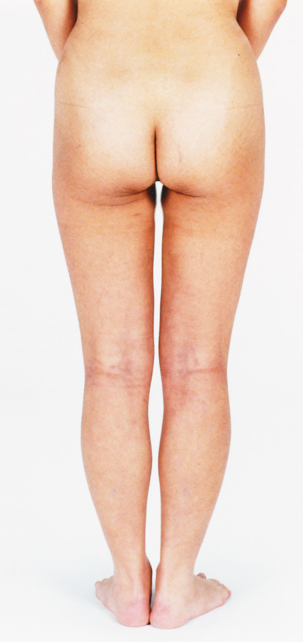 脂肪吸引,太もも全体（前面、後面、内側、外側、膝上）とふくらはぎの脂肪吸引をした30代女性の症例写真,After,ba_shibokyuin37_b.jpg