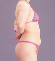 脂肪吸引,脂肪吸引の症例　上腹部下腹部,Before,ba_shibokyuin47_b.jpg