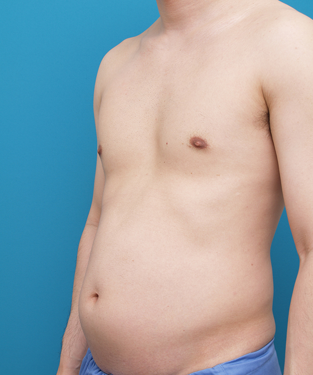 症例写真,お腹回りを全体的に脂肪吸引し、ぽっこりお腹を引っ込めた30代男性の症例写真,Before,ba_shibokyuin49_b.jpg