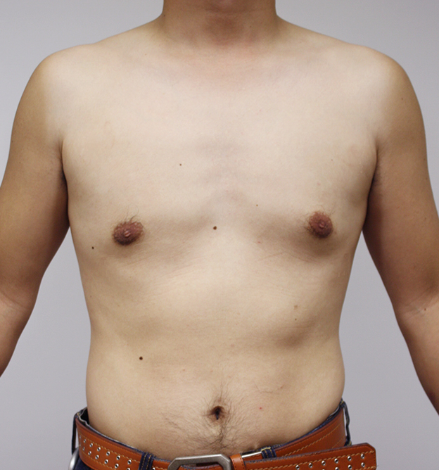 女性化乳房除去,脂肪吸引の症例写真　胸部、腹部,After,ba_shibokyuin50_b.jpg