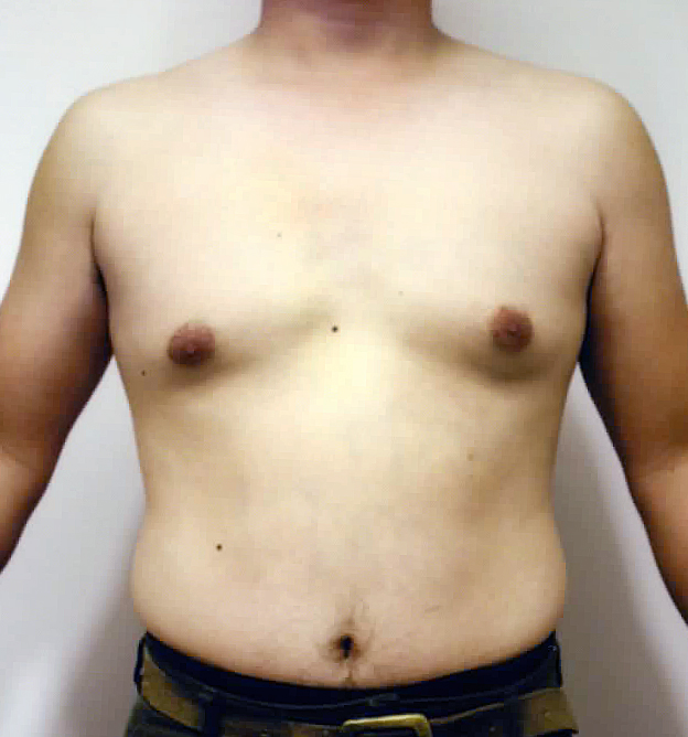 脂肪吸引,脂肪吸引の症例写真　胸部、腹部,Before,ba_shibokyuin50_b.jpg