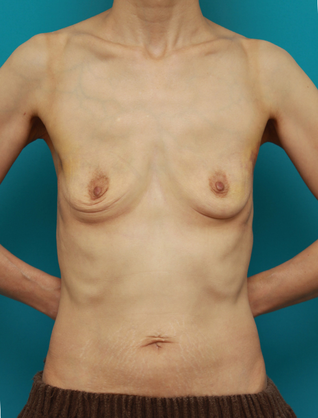 胸のシリコンプロテーゼ抜き（除去）,35年前に当院で豊胸手術をして、全く問題はないが、ご本人の希望でプロテーゼを抜いた症例写真,1週間後,mainpic_modify01c.jpg