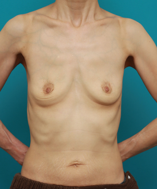 胸のシリコンプロテーゼ抜き（除去）,35年前に当院で豊胸手術をして、全く問題はないが、ご本人の希望でプロテーゼを抜いた症例写真,1ヶ月後,mainpic_modify01d.jpg