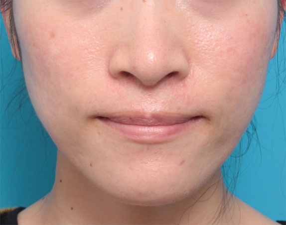 症例写真,30代女性にボツリヌストキシン注射（エラ、プチ小顔術）を行い、頬が痩けたり、顔が弛むことなく小顔にした症例写真の術前術後画像,After（2ヶ月後）,ba_botox14_b.jpg