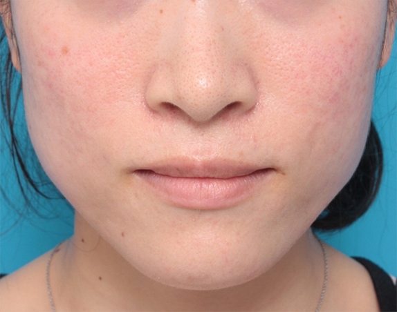 ボツリヌストキシン注射（エラ、プチ小顔術）,30代女性にボツリヌストキシン注射（エラ、プチ小顔術）を行い、頬が痩けたり、顔が弛むことなく小顔にした症例写真の術前術後画像,Before,ba_botox14_b.jpg