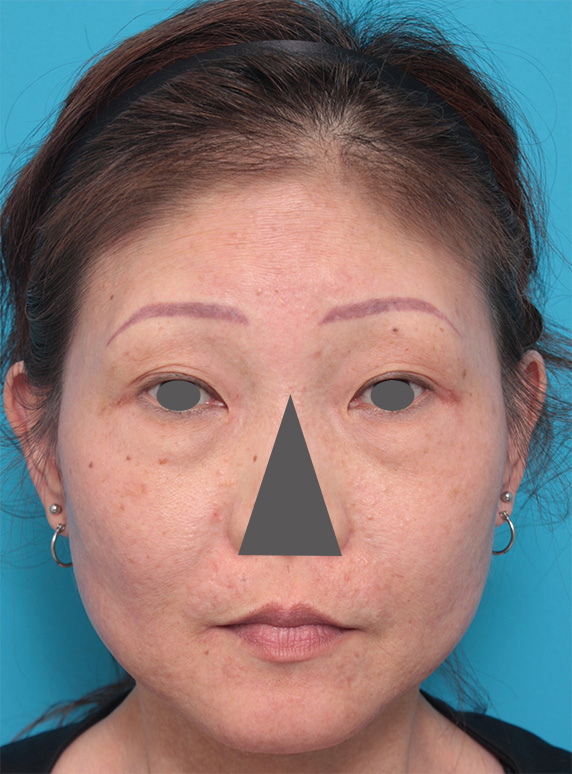 50代女性にボツリヌストキシン注射（エラ、プチ小顔術）を行い、頬が痩けたり顔がたるむことなく小顔になった症例写真,After（2ヶ月後）,ba_botox15_a01.jpg
