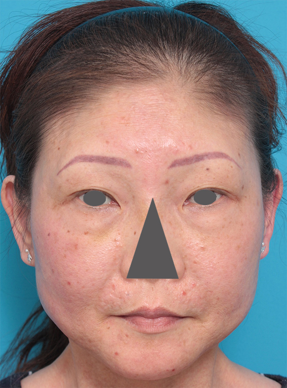ボツリヌストキシン注射（エラ、プチ小顔術）,50代女性にボツリヌストキシン注射（エラ、プチ小顔術）を行い、頬が痩けたり顔がたるむことなく小顔になった症例写真,Before,ba_botox15_b.jpg