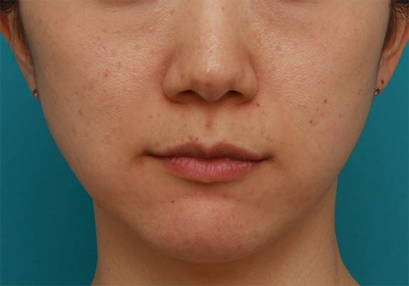 ボツリヌストキシン注射（エラ、プチ小顔術）,ボツリヌストキシン注射（エラ、プチ小顔術）で、顎関節症、歯軋りが改善し、小顔にもなった症例写真の術前術後画像,After（2ヶ月後）,ba_botox17_b.jpg