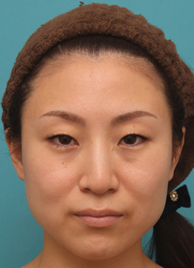 ボツリヌストキシン注射（エラ、プチ小顔術）,ボツリヌストキシン注射（エラ、プチ小顔術）でほっそりした小顔になった女性の症例写真の術前術後画像,注射前,mainpic_botox04a.jpg