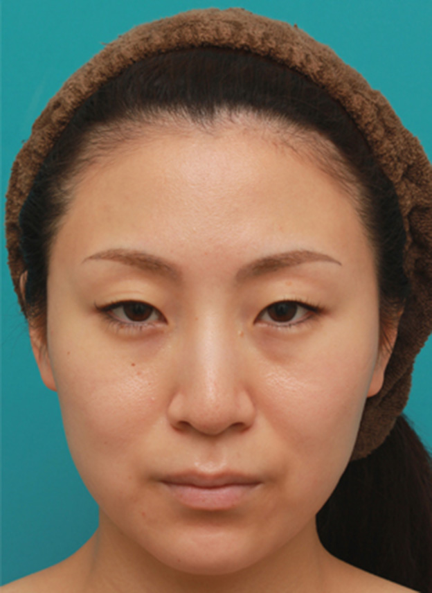 ボツリヌストキシン注射（エラ、プチ小顔術）,ボツリヌストキシン注射（エラ、プチ小顔術）でほっそりした小顔になった女性の症例写真の術前術後画像,1ヶ月後,mainpic_botox04c.jpg