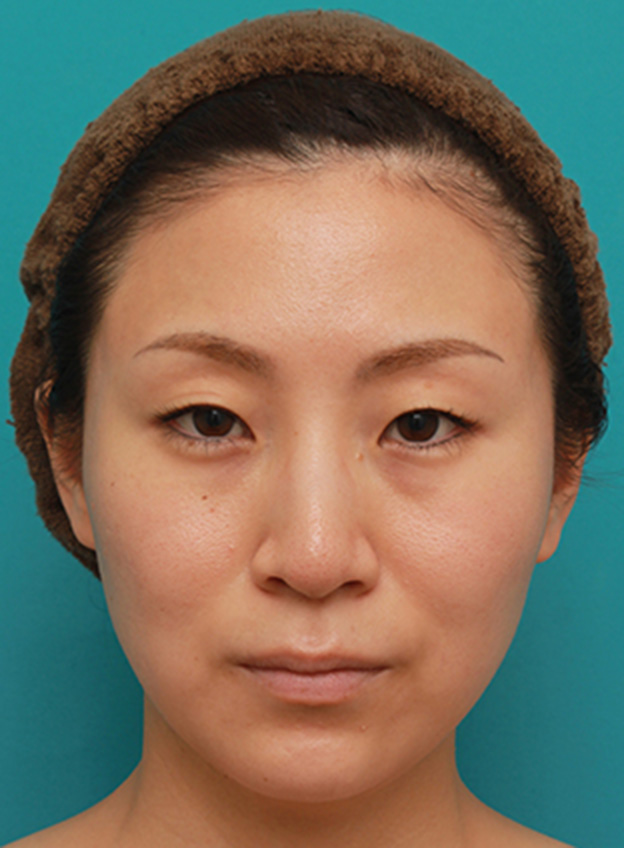 ボツリヌストキシン注射（エラ、プチ小顔術）,ボツリヌストキシン注射（エラ、プチ小顔術）でほっそりした小顔になった女性の症例写真の術前術後画像,4ヶ月後,mainpic_botox04d.jpg
