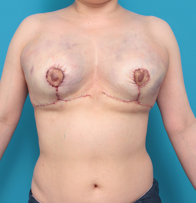 乳房縮小手術（マンマリダクション）,他院で行われた乳房縮小手術（マンマリダクション）の修正手術の症例写真,手術直後,mainpic_modify02b.jpg