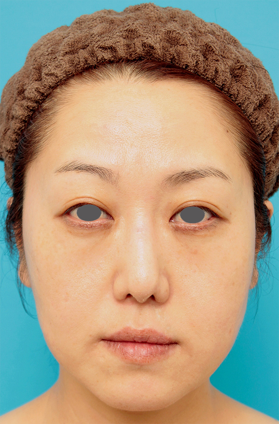症例写真,バッカルファット除去手術の症例写真 頬のたるみが気になる40代女性,After（3ヶ月後）,buccalfat03_b.jpg