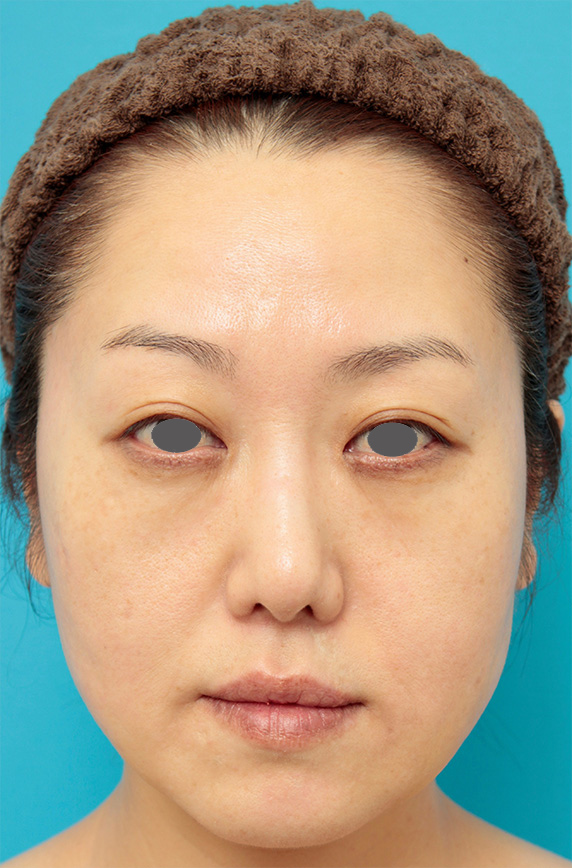 症例写真,バッカルファット除去手術の症例写真 頬のたるみが気になる40代女性,Before,buccalfat03_b.jpg