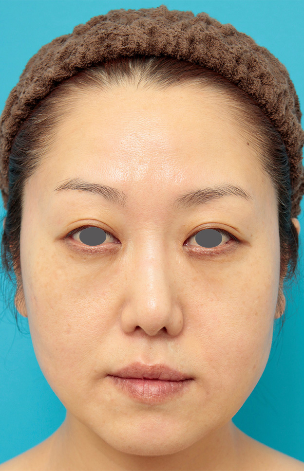 症例写真,バッカルファット除去手術の症例写真 頬のたるみが気になる40代女性,手術前,mainpic_buccalfat02a.jpg