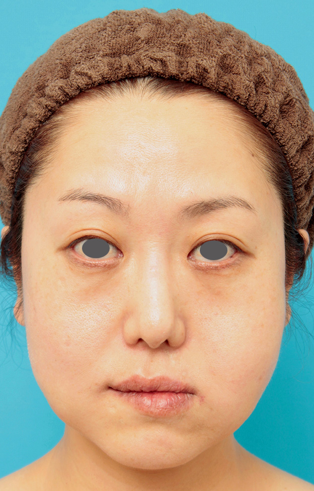 症例写真,バッカルファット除去手術の症例写真 頬のたるみが気になる40代女性,手術直後,mainpic_buccalfat02b.jpg