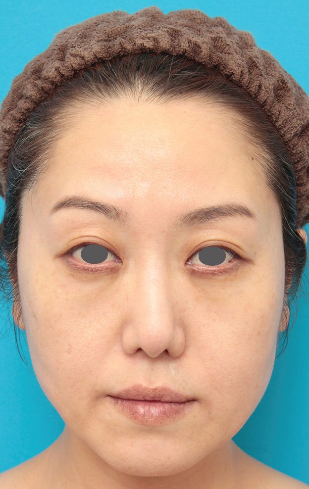 バッカルファット除去,バッカルファット除去手術の症例写真 頬のたるみが気になる40代女性,手術翌日,mainpic_buccalfat02c.jpg