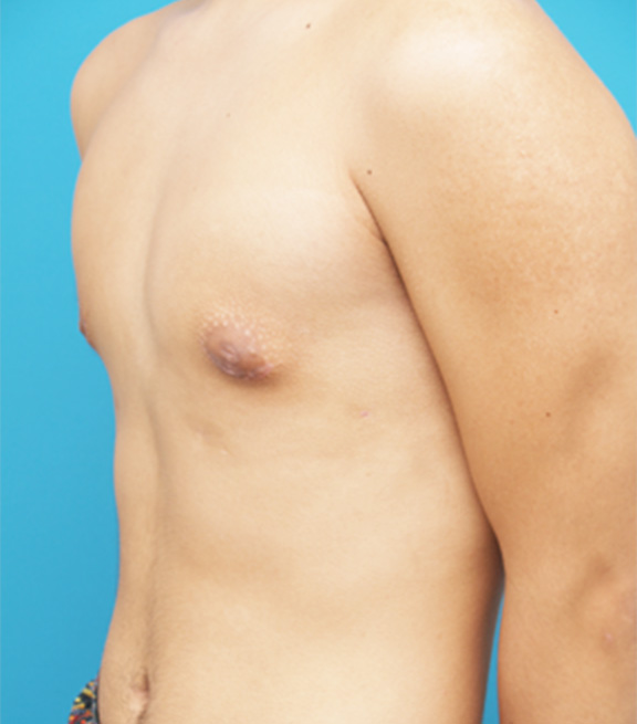 女性化乳房除去の症例写真　脂肪吸引＋乳腺除去,After,ba_gynecomastia_pic05_a01.jpg