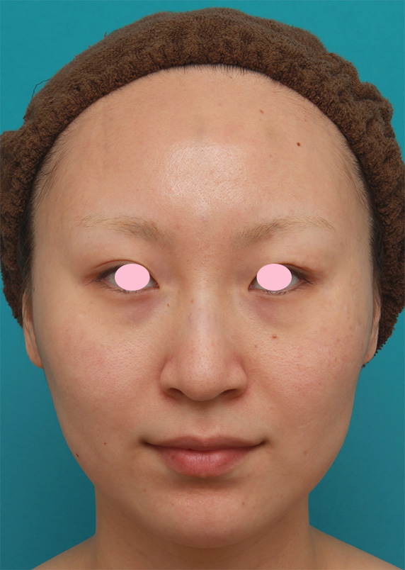 20代女性にバッカルファット切除を行い、小顔効果、頬たるみ老化予防効果を出した症例写真の術前術後画像,Before,ba_buccalfat06_b.jpg
