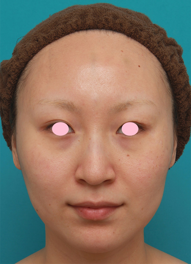 症例写真,20代女性にバッカルファット切除を行い、小顔効果、頬たるみ老化予防効果を出した症例写真の術前術後画像,手術前,mainpic_buccalfat04a.jpg