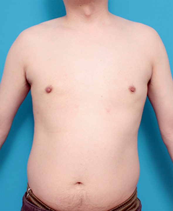 女性化乳房除去,女性化乳房の症例写真,After,ba_gynecomastia_pic08_b.jpg