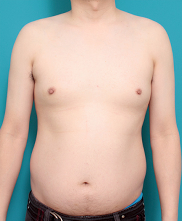 女性化乳房除去,女性化乳房の症例写真,Before,ba_gynecomastia_pic08_b.jpg