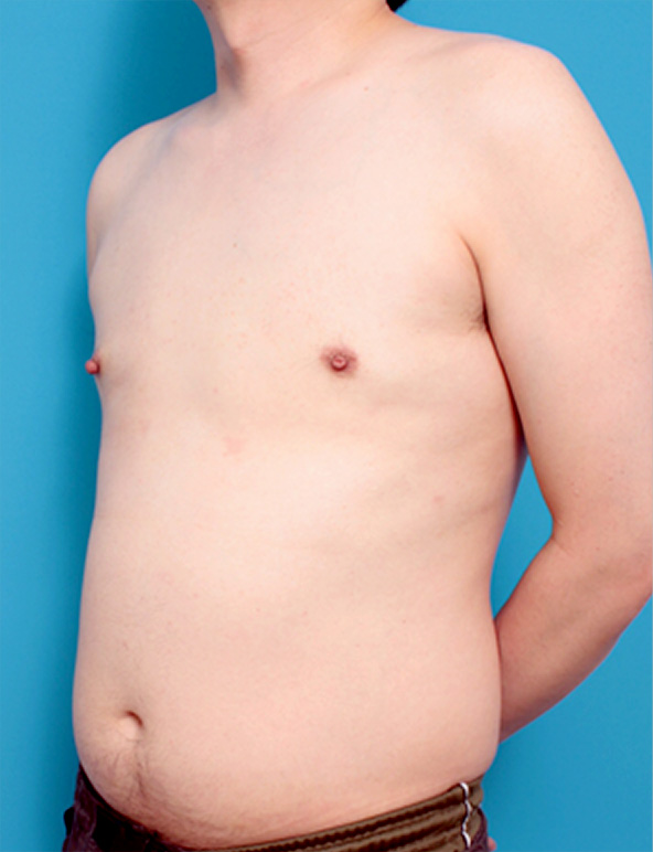 女性化乳房除去,女性化乳房の症例写真,After,ba_gynecomastia_pic09_b.jpg