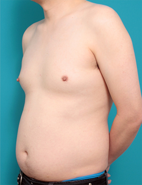 女性化乳房除去,女性化乳房の症例写真,Before,ba_gynecomastia_pic09_b.jpg