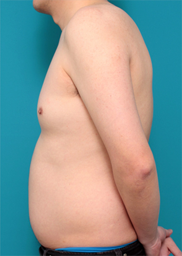 女性化乳房除去,女性化乳房の症例写真,Before,ba_gynecomastia_pic10_b.jpg