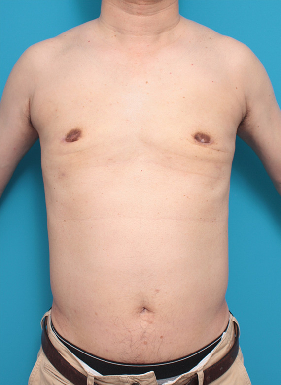 巨大な女性化乳房の手術症例写真,After,ba_gynecomastia_pic11_a01.jpg