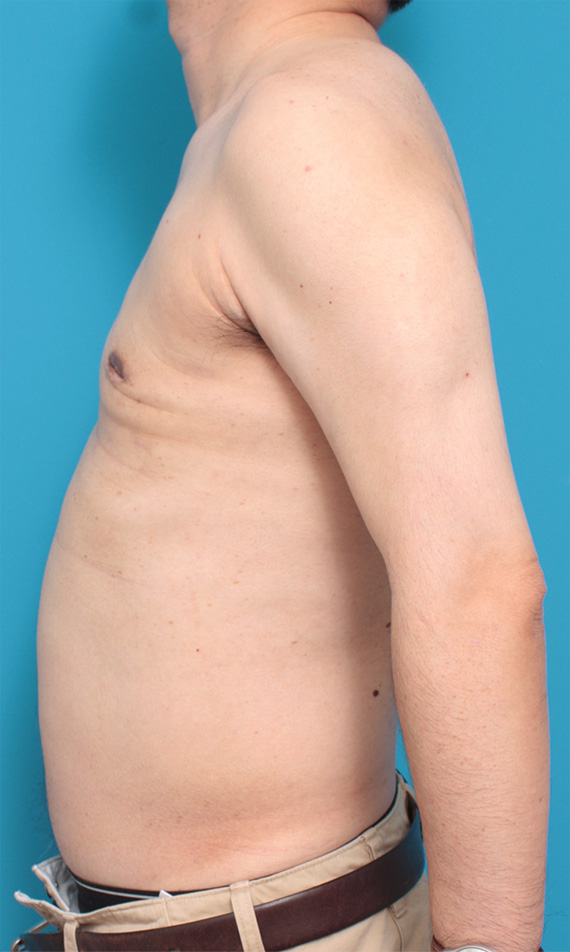 症例写真,巨大な女性化乳房の手術症例写真,After,ba_gynecomastia_pic13_b.jpg