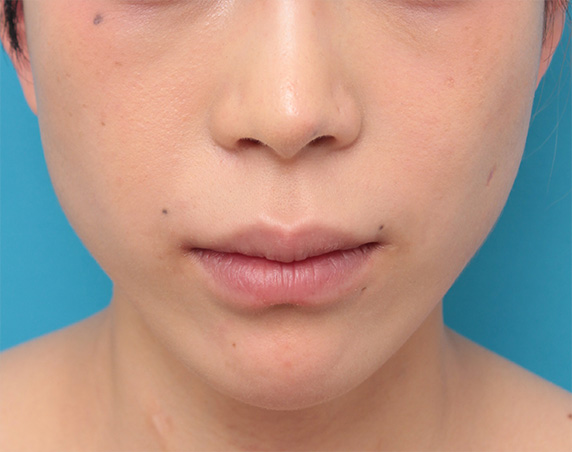 バッカルファットを除去し頬をスッキリさせた20代女性の症例写真の術前術後画像,After（6ヶ月後）,ba_buccalfat07_a01.jpg