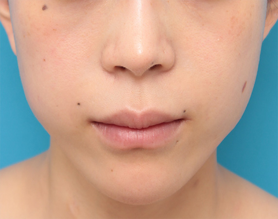 バッカルファットを除去し頬をスッキリさせた20代女性の症例写真の術前術後画像,Before,ba_buccalfat07_b.jpg