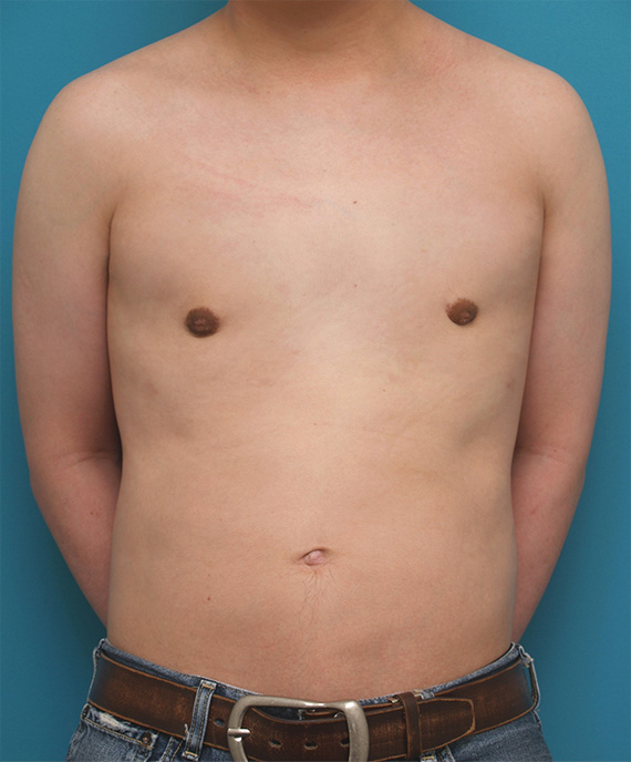 女性化乳房除去,ちょっと大きめの女性化乳房症例写真,After,ba_gynecomastia_pic14_b.jpg