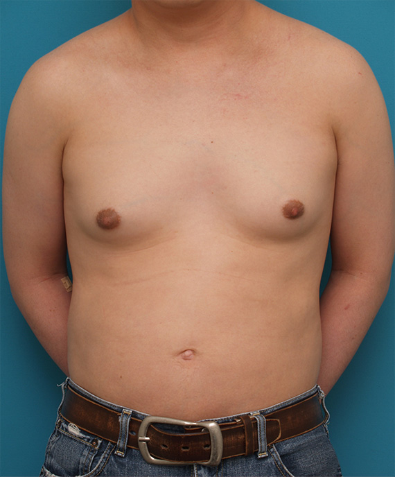 女性化乳房除去,ちょっと大きめの女性化乳房症例写真,Before,ba_gynecomastia_pic14_b.jpg