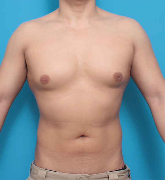 ボディービルダーが筋力増強剤の副作用でなったと思われる女性化乳房の手術の症例写真,Before,ba_gynecomastia_pic16_b.jpg