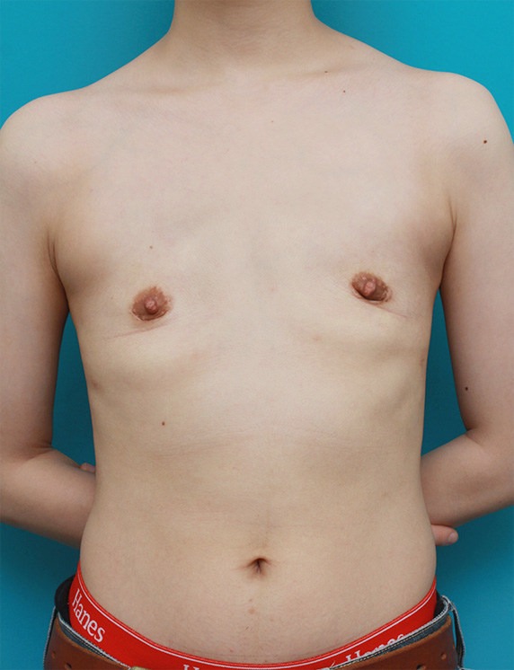 乳房切除（性同一性障害 GID FtM）,GIDの患者様に対して、皮膚を切除せずに乳腺除去を行った症例写真,After,ba_gynecomastia_pic19_b.jpg